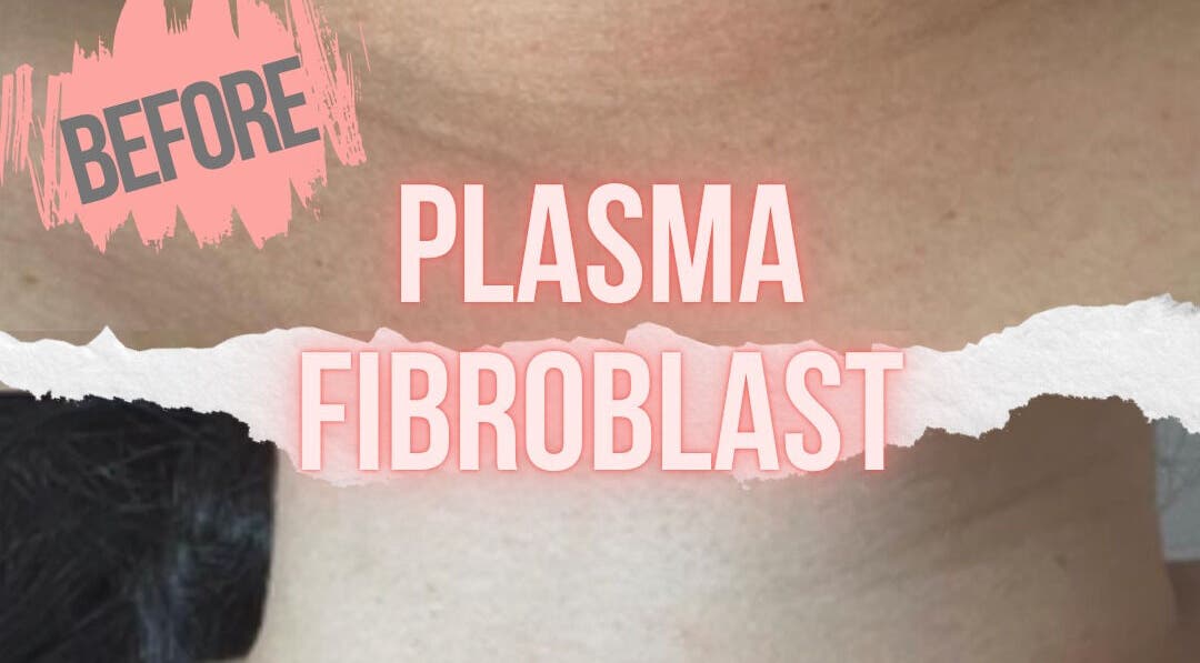 Plasma Fibroblast treatment at Tam’s Lash Studio & Radiant Skin Aesthetics, Umhlanga, KwaZulu-Natal, ZA.