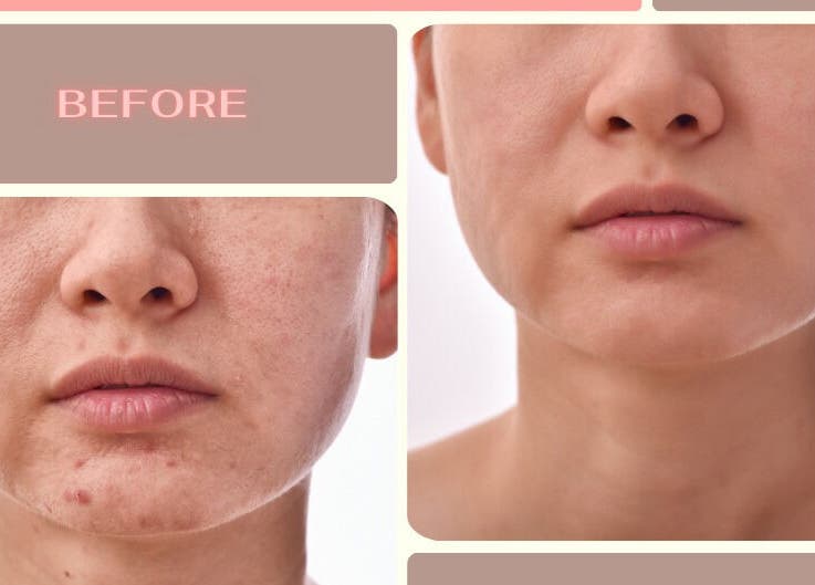 Before and after skin treatment at Tam’s Lash Studio & Radiant Skin Aesthetics, Umhlanga, KwaZulu-Natal, ZA.