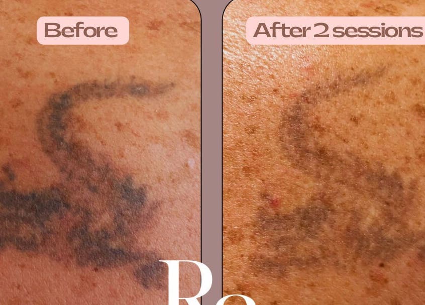 Tattoo fading comparison after 2 sessions at Tam’s Lash Studio & Radiant Skin Aesthetics, Umhlanga, KwaZulu-Natal, ZA.