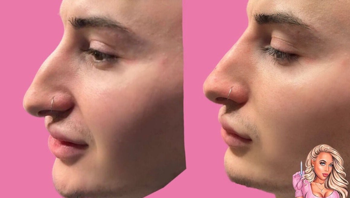 Nose transformation before and after at HLC Aesthetics in Abbeymead, England, GB with pink background.