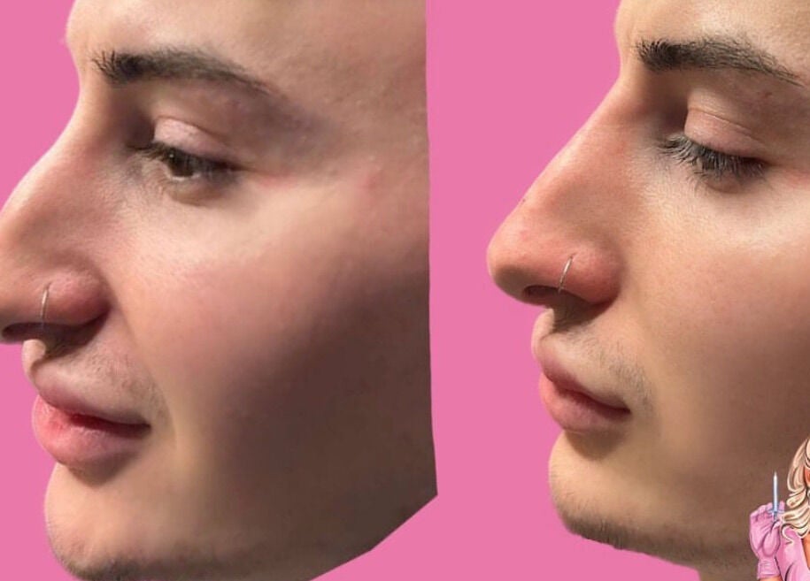 Nose transformation before and after at HLC Aesthetics in Abbeymead, England, GB with pink background.