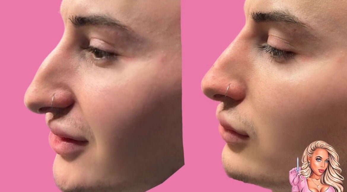 Nose transformation before and after at HLC Aesthetics in Abbeymead, England, GB with pink background.