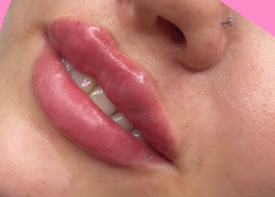 Close-up of enhanced lips at HLC Aesthetics, Abbeymead, England, GB showcasing expert cosmetic treatments.