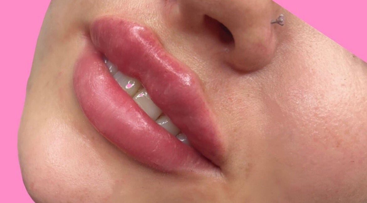 Close-up of enhanced lips at HLC Aesthetics, Abbeymead, England, GB showcasing expert cosmetic treatments.