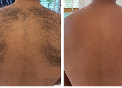 Before and after back hair removal at SkinFIX Medical Aesthetics & Regeneration Clinic, Tunapuna/piarco Regional Corporation, TT.