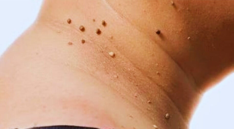 Close-up of skin blemishes treated at SkinFIX Medical Aesthetics & Regeneration Clinic, Tunapuna/piarco Regional Corporation, TT.