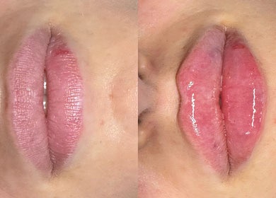 Before and after lip enhancement at InBeauty | Iuliana Aesthetics, Writtle, England, GB.