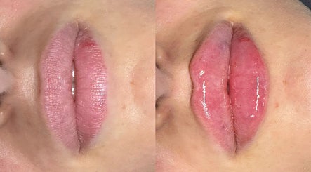 Before and after lip enhancement at InBeauty | Iuliana Aesthetics, Writtle, England, GB.