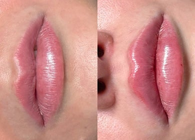 Before and after lip enhancement at InBeauty | Iuliana Aesthetics, Writtle, England, GB.