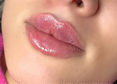 Glamorous lip treatment result at InBeauty | Iuliana Aesthetics, Writtle, England, GB showcasing glossy, full lips.