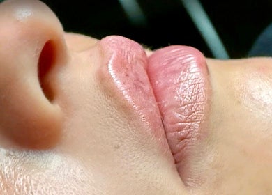 Close-up of lips after treatment at InBeauty | Iuliana Aesthetics in Writtle, England, GB.