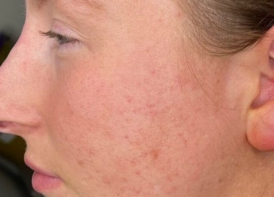 Side profile of skin treatment at LUMI AESTHETICS, Pudsey, England, GB, highlighting improved complexion.