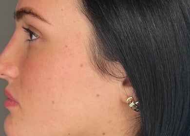 Side profile view highlighting natural beauty at LUMI AESTHETICS, Pudsey, England, GB.