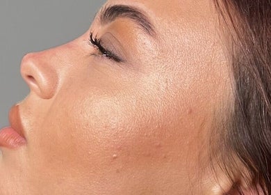 Side view of a woman's smooth, glowing skin at LUMI AESTHETICS, Pudsey, England, GB.