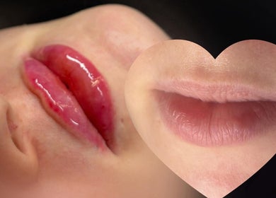 Lip enhancement at MISSY Aesthetics & Gals in Douglas, Douglas, IM. Before and after image of plump lips.