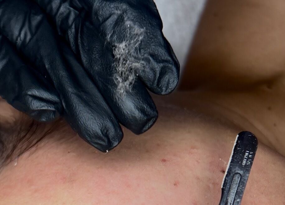 Close-up of skin exfoliation at Filtrdxrosy, Boston, Massachusetts, US, showcasing detailed beauty service.