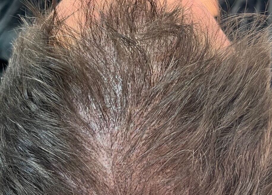 Scalp micropigmentation at Scalpture Ink, Johannesburg, Gauteng, ZA, showcasing fine hair detail.