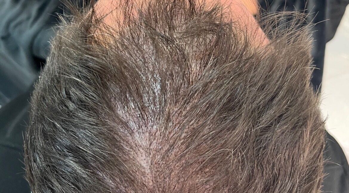 Scalp micropigmentation at Scalpture Ink, Johannesburg, Gauteng, ZA, showcasing fine hair detail.