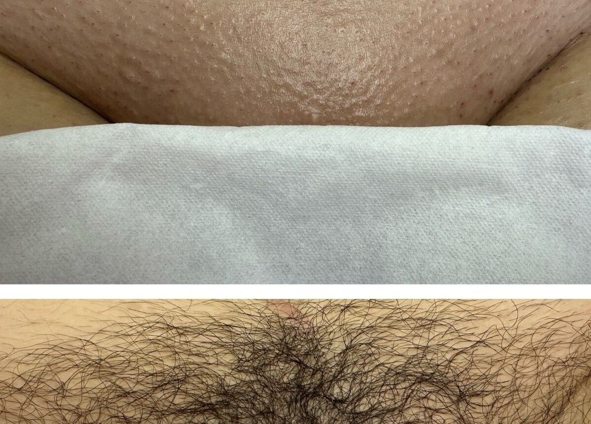 Before and after leg waxing at Bare Kitty Wax, Inverness, Illinois, US, showcasing hair removal results.