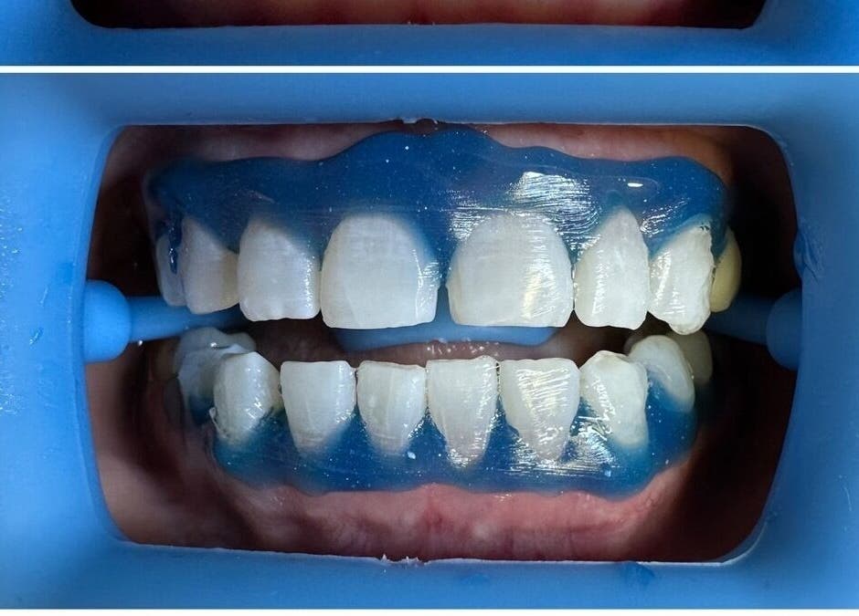 Teeth whitening preparation at Bare Kitty Wax, Inverness, Illinois, US.