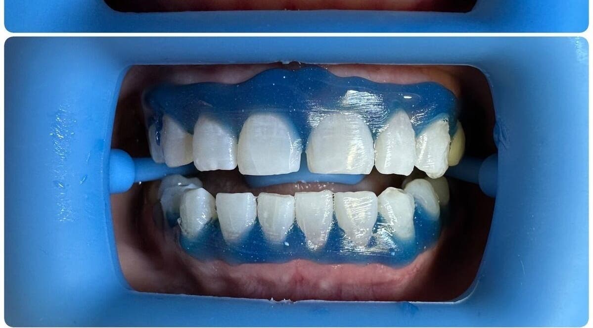 Teeth whitening preparation at Bare Kitty Wax, Inverness, Illinois, US.