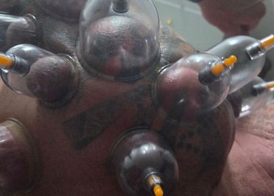 Cupping therapy session at Therapeia Sports Massage in Sandton, Gauteng, ZA featuring multiple cups on a client.