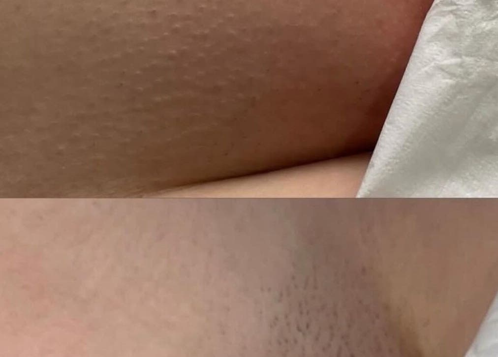 Before and after skin treatment at Southern Laser Carterton, Carterton, England, GB showcasing smoother skin.