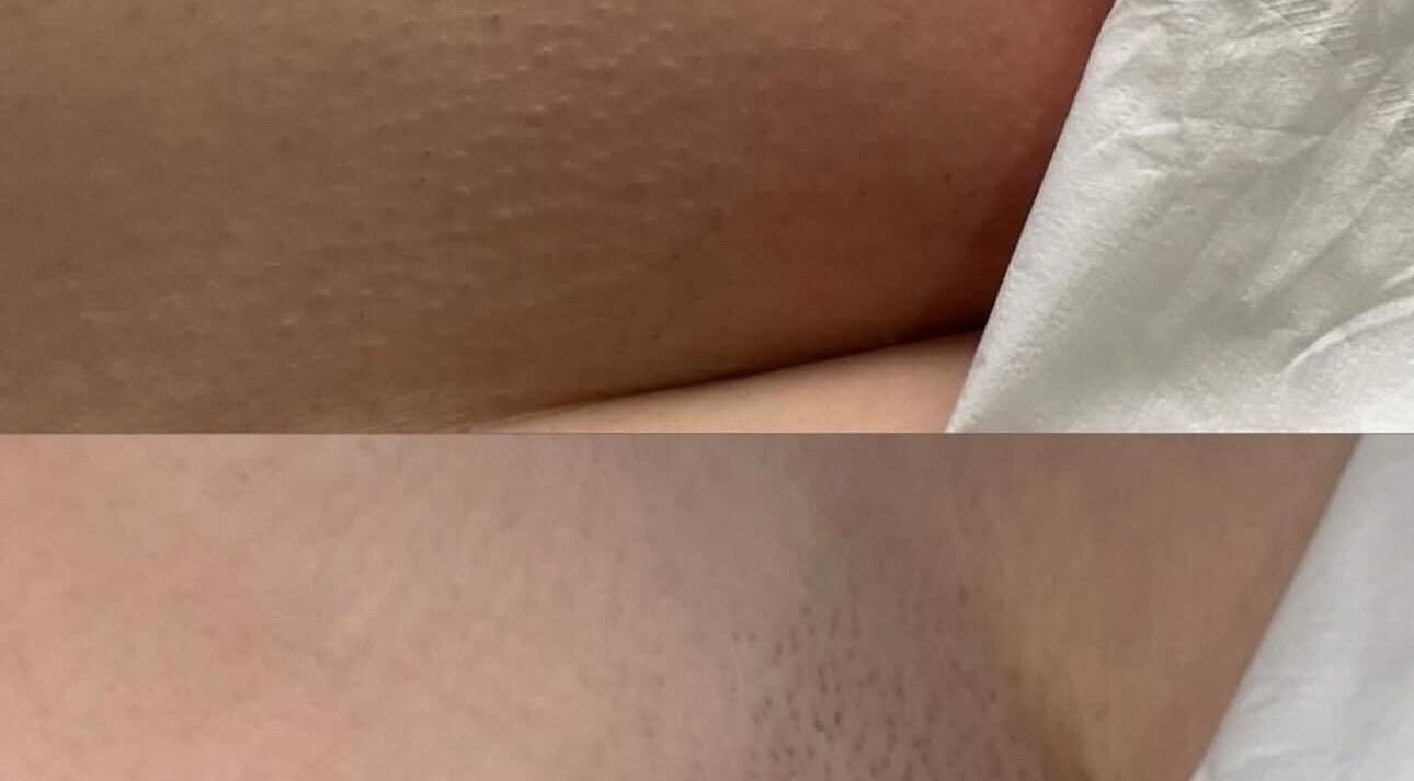 Before and after skin treatment at Southern Laser Carterton, Carterton, England, GB showcasing smoother skin.