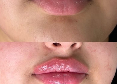 Lip enhancement at Body Secrets - West London, enhancing and plumping lips in London, England, GB.
