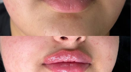 Lip enhancement at Body Secrets - West London, enhancing and plumping lips in London, England, GB.