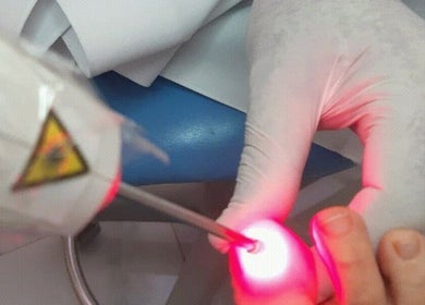 Laser nail treatment at Special Nails Clinic in Deerfield Beach, Florida, US.