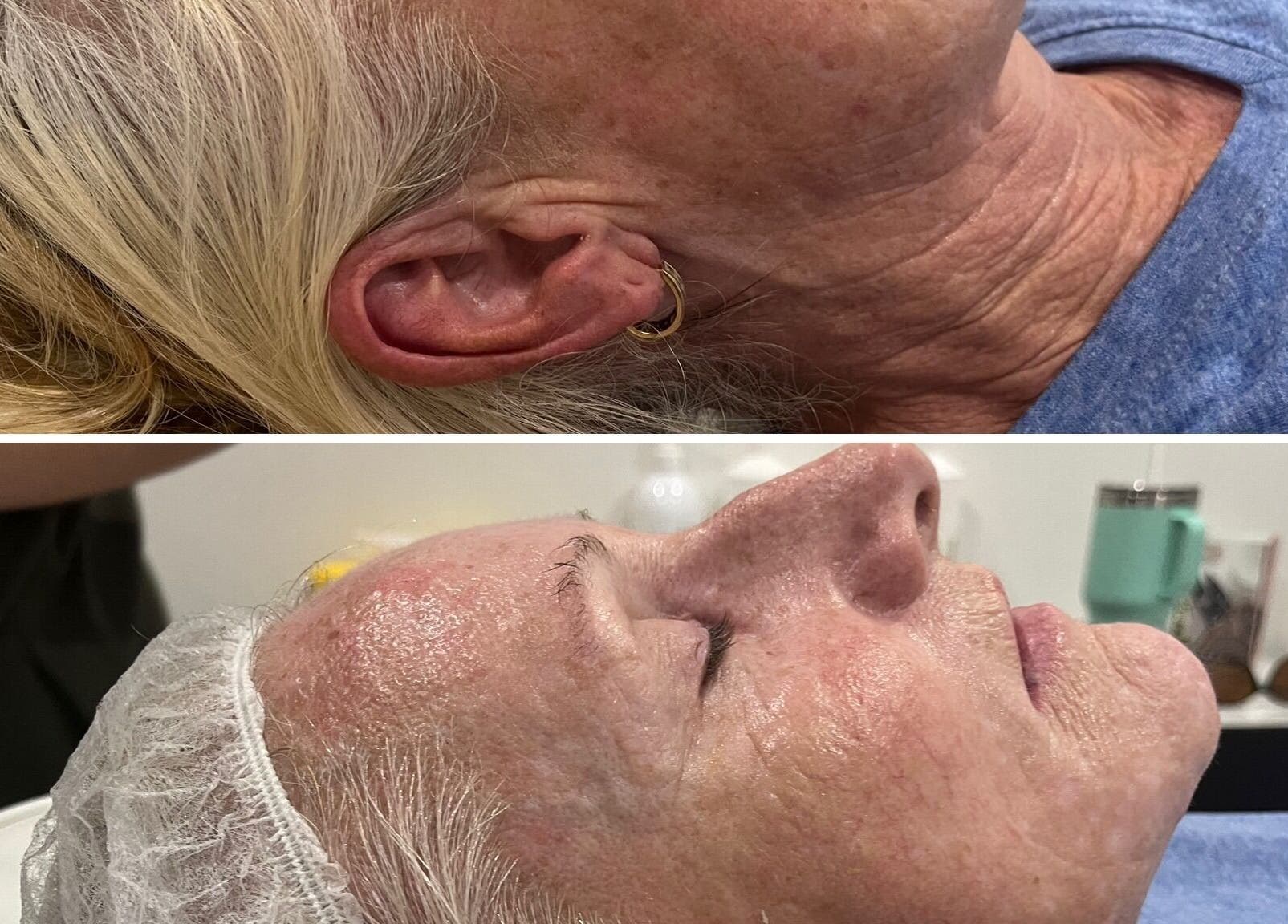 Before and after facial at Oh My Skin Gunnedah, New South Wales, AU showing skin rejuvenation results.