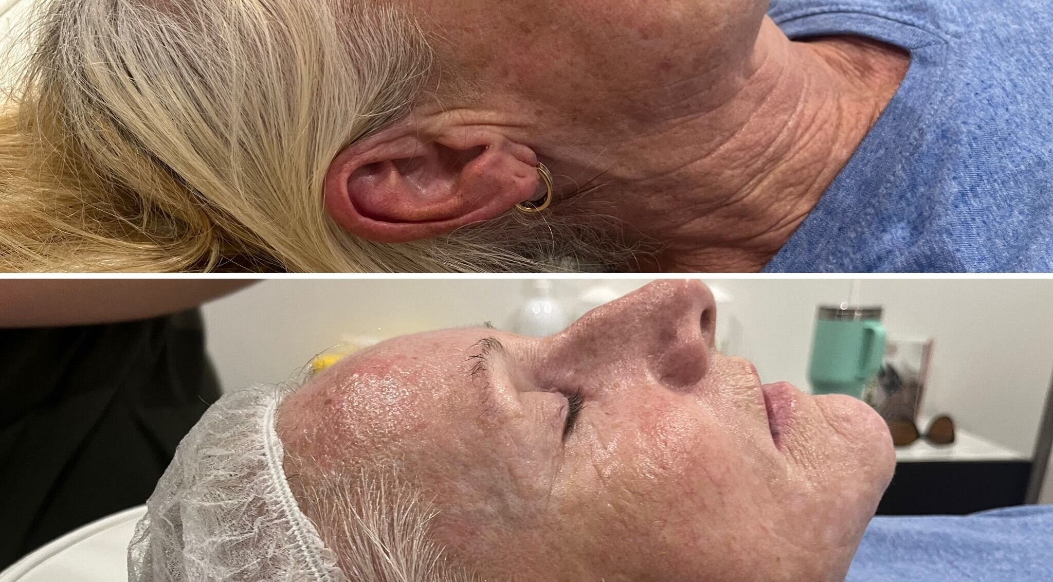 Before and after facial at Oh My Skin Gunnedah, New South Wales, AU showing skin rejuvenation results.