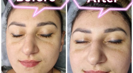 NS Beauty Time - Laser Hair Removal - Hydrafacial – obraz 2