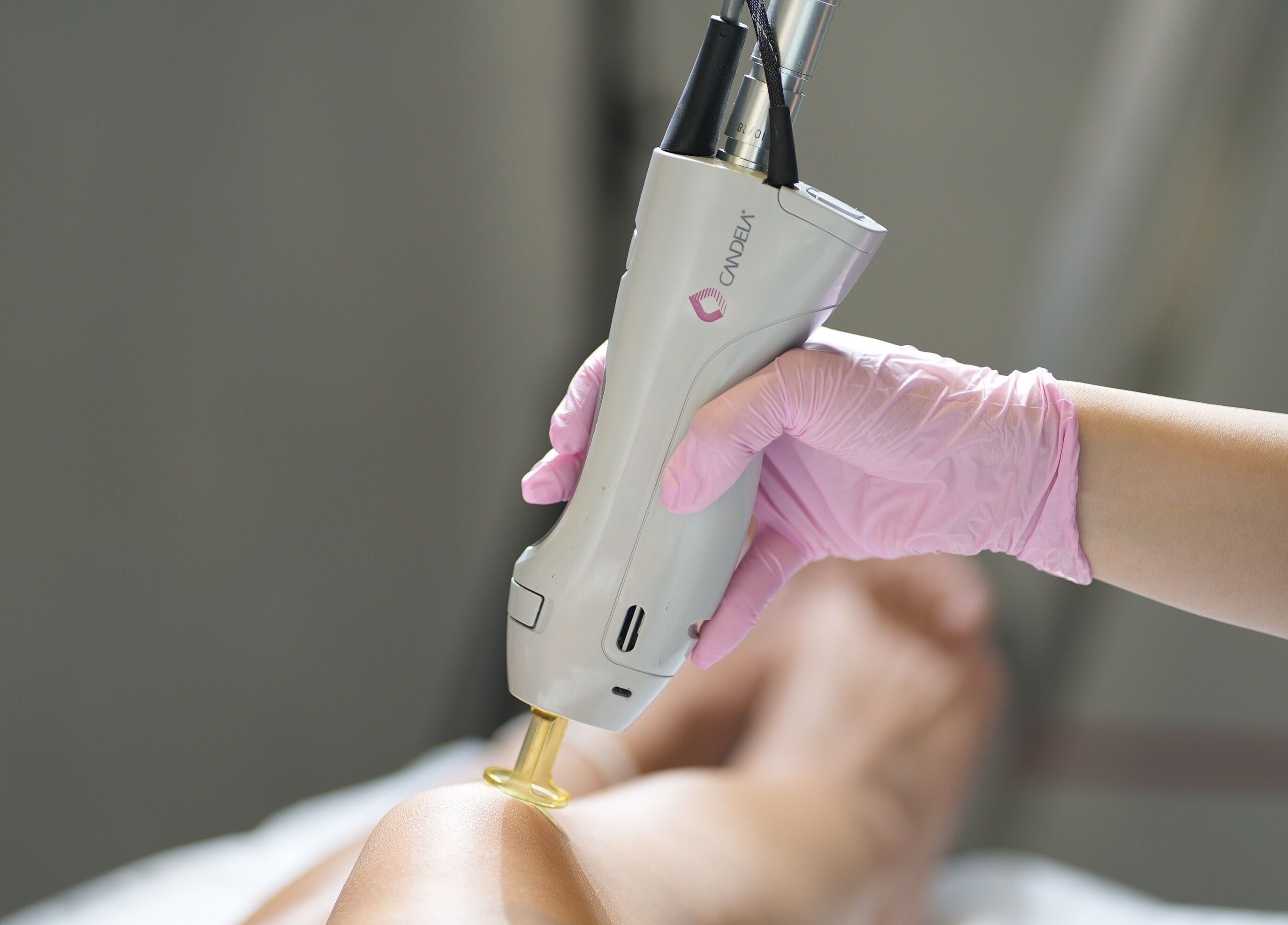 Lézeres kezelés az inglow aesthetics Budapesten. Sima bőr a szakértői gondoskodás révén.