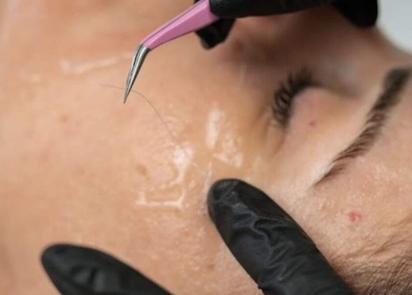 Trattamento viso presso VRF Collagen Point PESCARA, Pescara, Abruzzo, IT con pinzette e dettagli pelle.