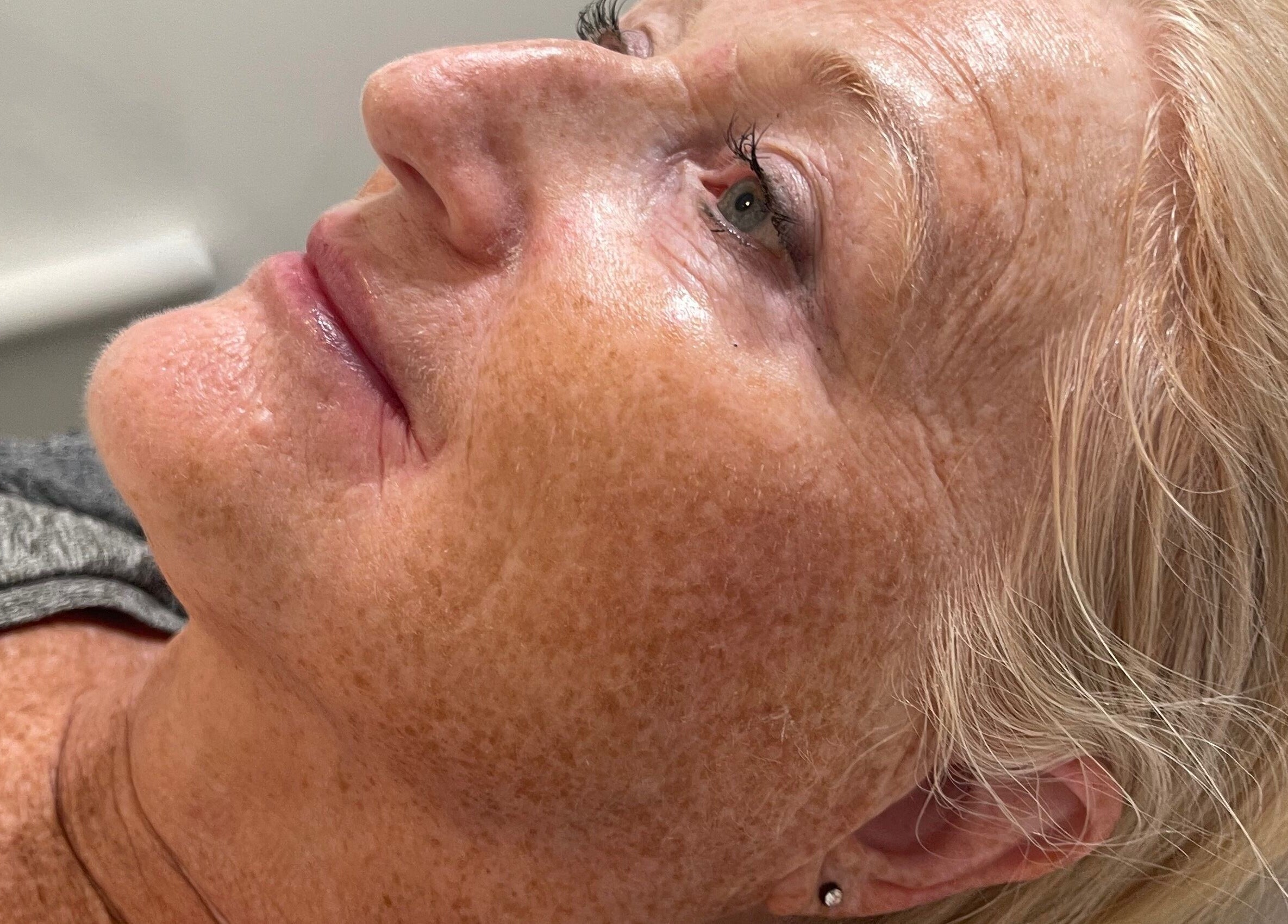 Close-up profile of a relaxed client receiving treatment at Emma Fox Aesthetics, Heybridge, England, GB.