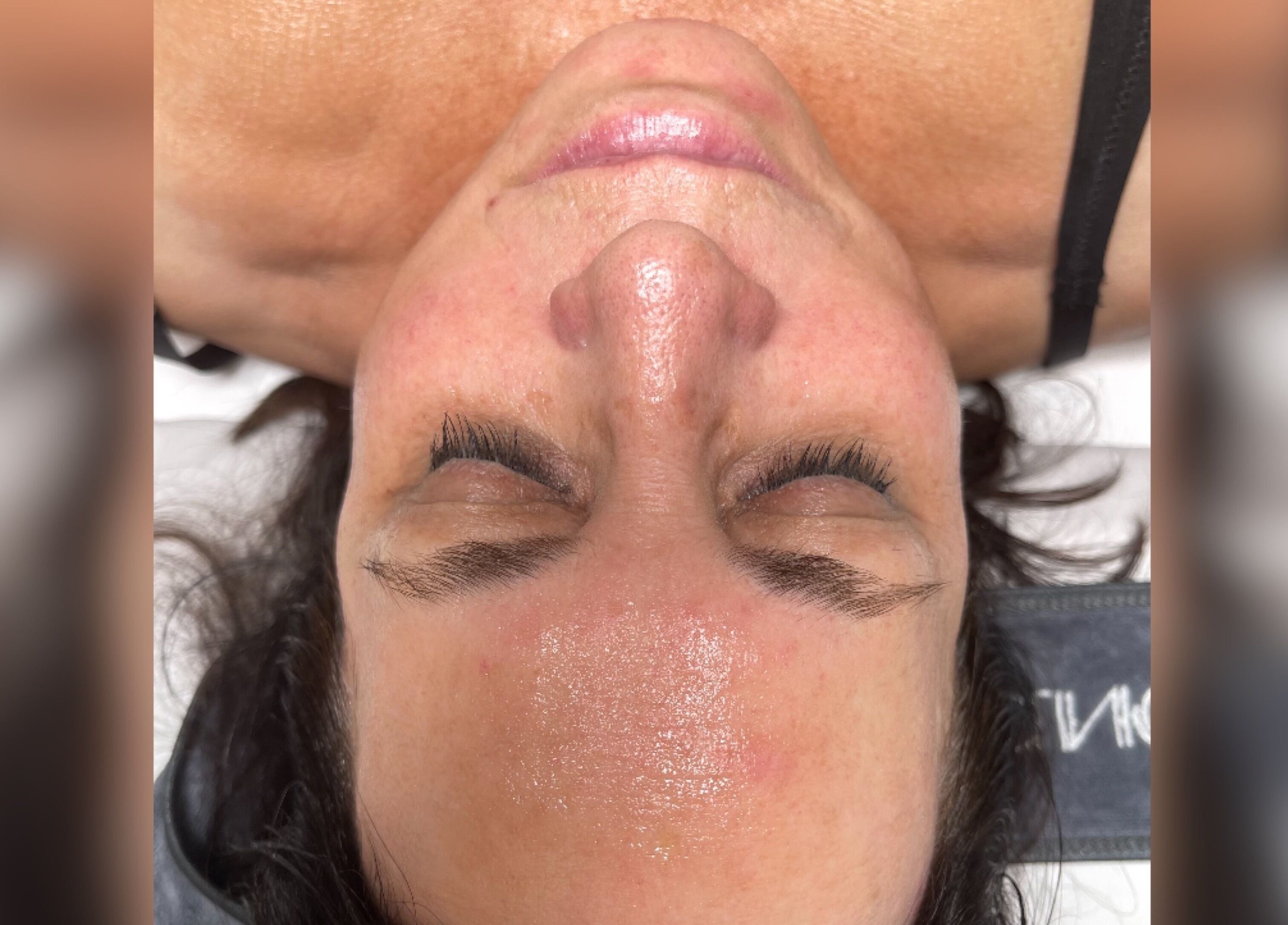 Close-up of a smooth, radiant face post-treatment at Emma Fox Aesthetics, Heybridge, England, GB.