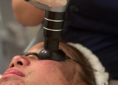 Facial laser treatment at Lueur Beauty and Wellness, Quezon City, Metro Manila, PH.