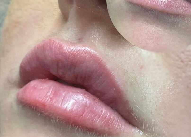 Lip enhancement at Sage beauty & aesthetics (former JJ Beauty), Wigan, England, GB. Close-up of enhanced lips.