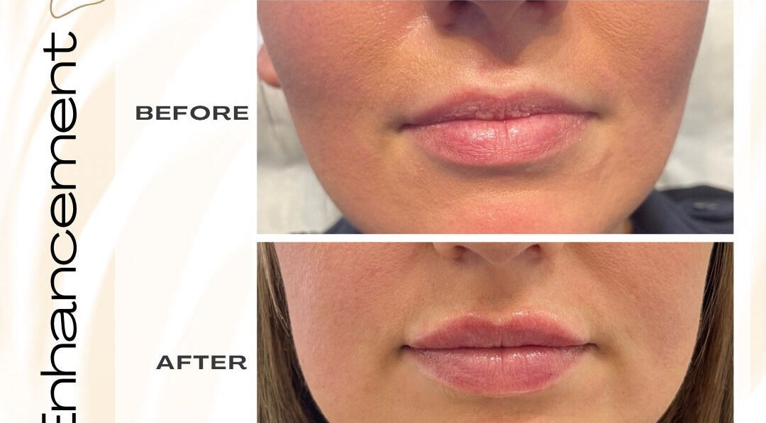 Before and after lip enhancement at Dermaesthetics by Caitlhan, Blackburn, England, GB. Noticeable volume and definition.