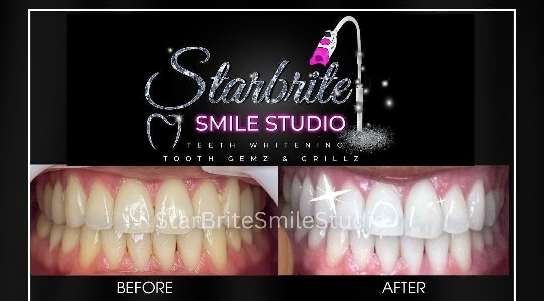 Before and after teeth whitening at StarBrite Smile Studio in Dallas, Texas, US showing a bright smile transformation.