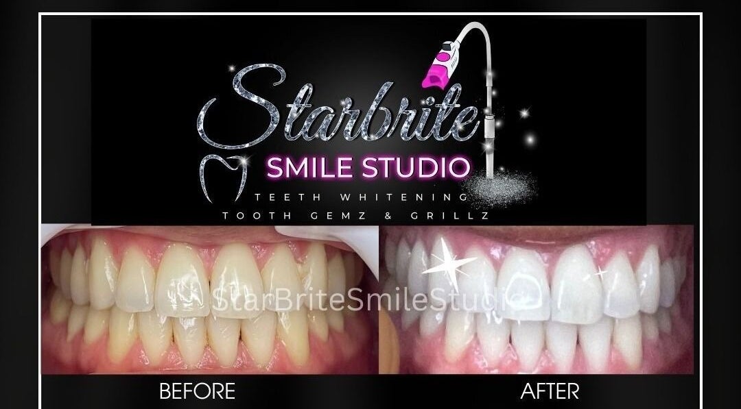 Before and after teeth whitening at StarBrite Smile Studio in Dallas, Texas, US showing a bright smile transformation.