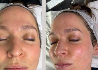 Close-up of a rejuvenated face post-treatment at Secret Skin Beauty, Fontwell, England, GB.