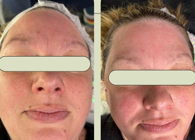 Before and after facial treatment at Secret Skin Beauty, Fontwell, England, GB showing skin revitalization.