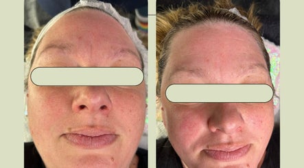 Before and after facial treatment at Secret Skin Beauty, Fontwell, England, GB showing skin revitalization.