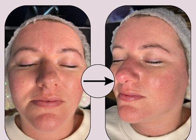 Before and after facial at Secret Skin Beauty, Fontwell, England, GB, showing enhanced skin glow and clarity.