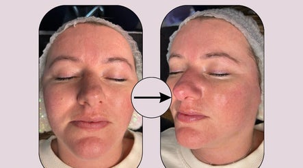 Before and after facial at Secret Skin Beauty, Fontwell, England, GB, showing enhanced skin glow and clarity.