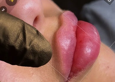 Lip enhancement at Paradox Aesthetics in Worcester, England, GB showcasing the procedure details.