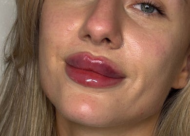 Enhanced lips with glossy finish at Paradox Aesthetics, Worcester, England, GB.